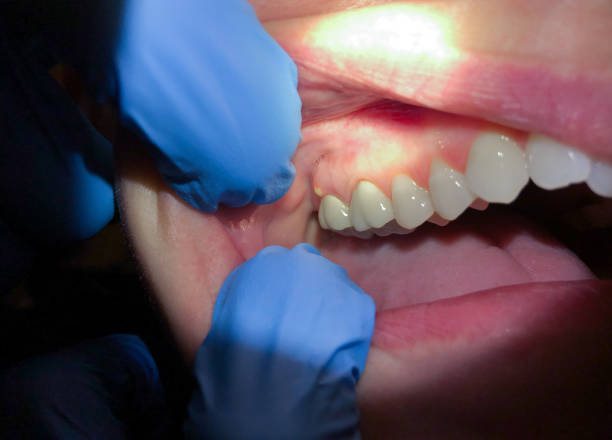 Best Broken or Chipped Tooth Repair in Fest Grove, OR